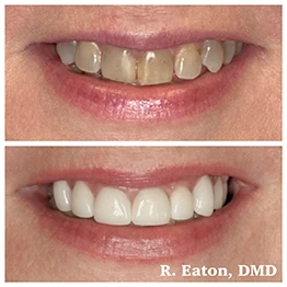 Before and after smile at Singing River Dentistry