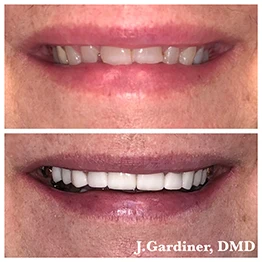 Before and after smile at Singing River Dentistry