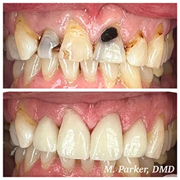 Before and after smile at Singing River Dentistry