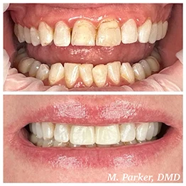 Before and after smile at Singing River Dentistry