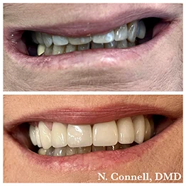 Before and after smile at Singing River Dentistry