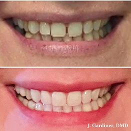 Before and after smile at Singing River Dentistry