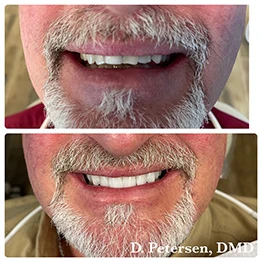 Before and after smile at Singing River Dentistry