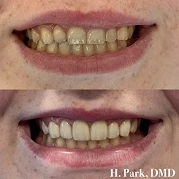 Before and after smile at Singing River Dentistry