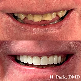 Before and after smile at Singing River Dentistry