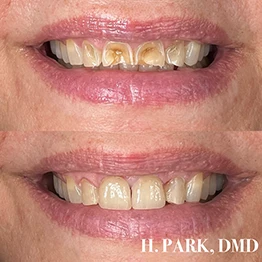 Before and after smile at Singing River Dentistry