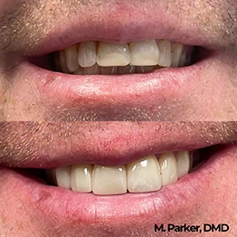 Before and after smile at Singing River Dentistry