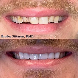 Before and after smile at Singing River Dentistry