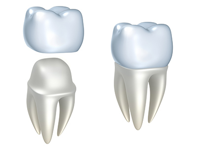 The Advantages of Zirconium Crowns