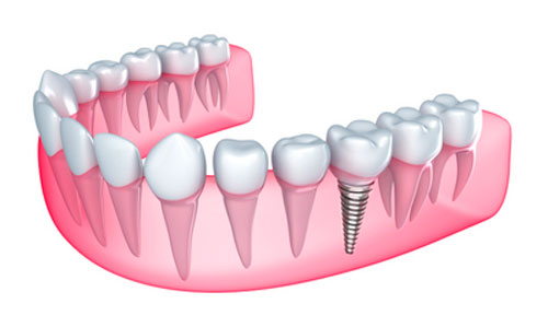 Facts About Dental Implant Recovery Process