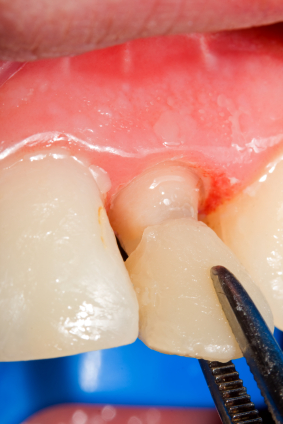 Veneers as an Alternative to Minor Orthodontics