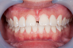 What Is A Frenectomy And Do I Need One?