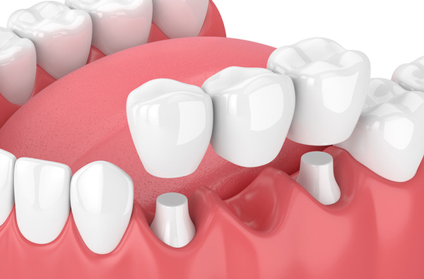 Rendering of jaw with dental bridge at Singing River Dentistry in Muscle Shoals, AL 