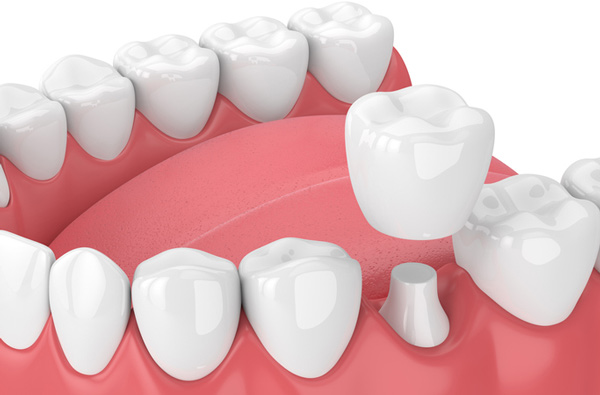 What a dental crown looks like - rendering of jaw with dental crown like the type used by us at Singing River Dentistry