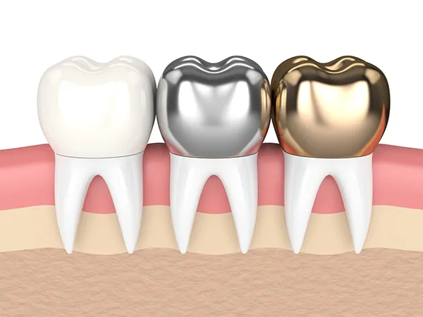 3D rendered cross-section view of three teeth with dental crowns made of different materials at Singing River Dentistry in Muscle Shoals, AL