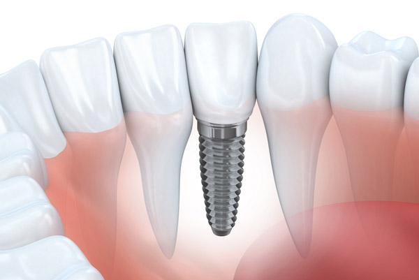 Diagram of dental implant in lower jaw provided by Singing River Dentistry in Muscle Shoals AL 35661 