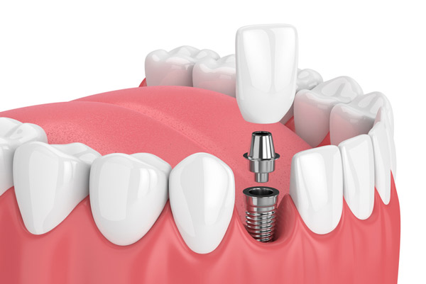 Rendering of dental implants at Singing River Dentistry.