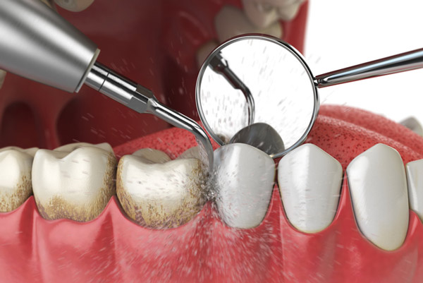 Diagram of teeth and gum cleaning at Singing River Dentistry