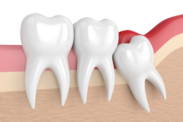 Illustration of an impacted wisdom tooth from Singing River Dentistry