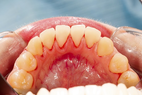 The Sooner You Stop Gum Disease, The Easier It Is to Treat