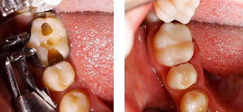 Dental filling before and after