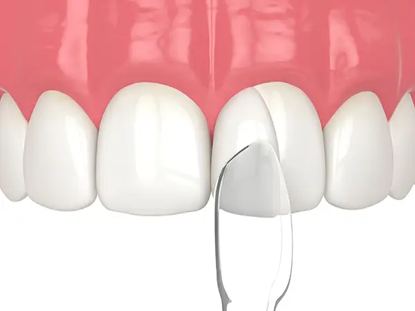 A close-up of the dental bonding procedure showing a composite resin layer being applied to a tooth.