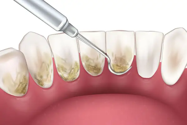 Close-up of a dental scaling procedure removing tartar and plaque from the front teeth.